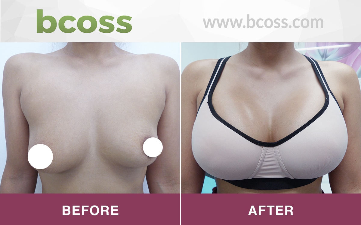 Breast Augmentation_24 – BCOSS Clinic : Cosmetic Surgery Bangkok